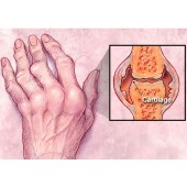 Rheumatoid Arthritis (4)